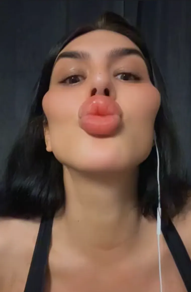 Godinama je punila obraze filerima, a sada je odlučila vratiti prirodno lice: Promjena je ogromna