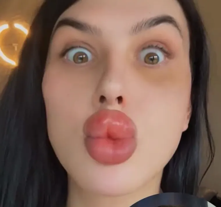 Godinama je punila obraze filerima, a sada je odlučila vratiti prirodno lice: Promjena je ogromna