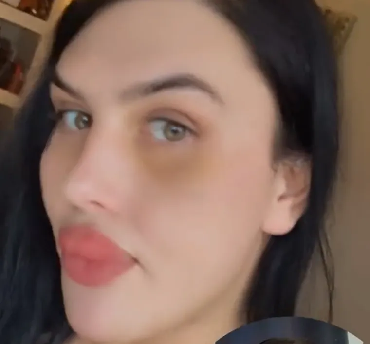 Godinama je punila obraze filerima, a sada je odlučila vratiti prirodno lice: Promjena je ogromna