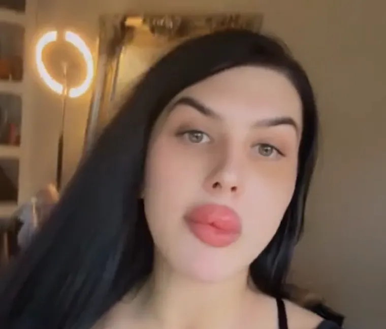 Godinama je punila obraze filerima, a sada je odlučila vratiti prirodno lice: Promjena je ogromna