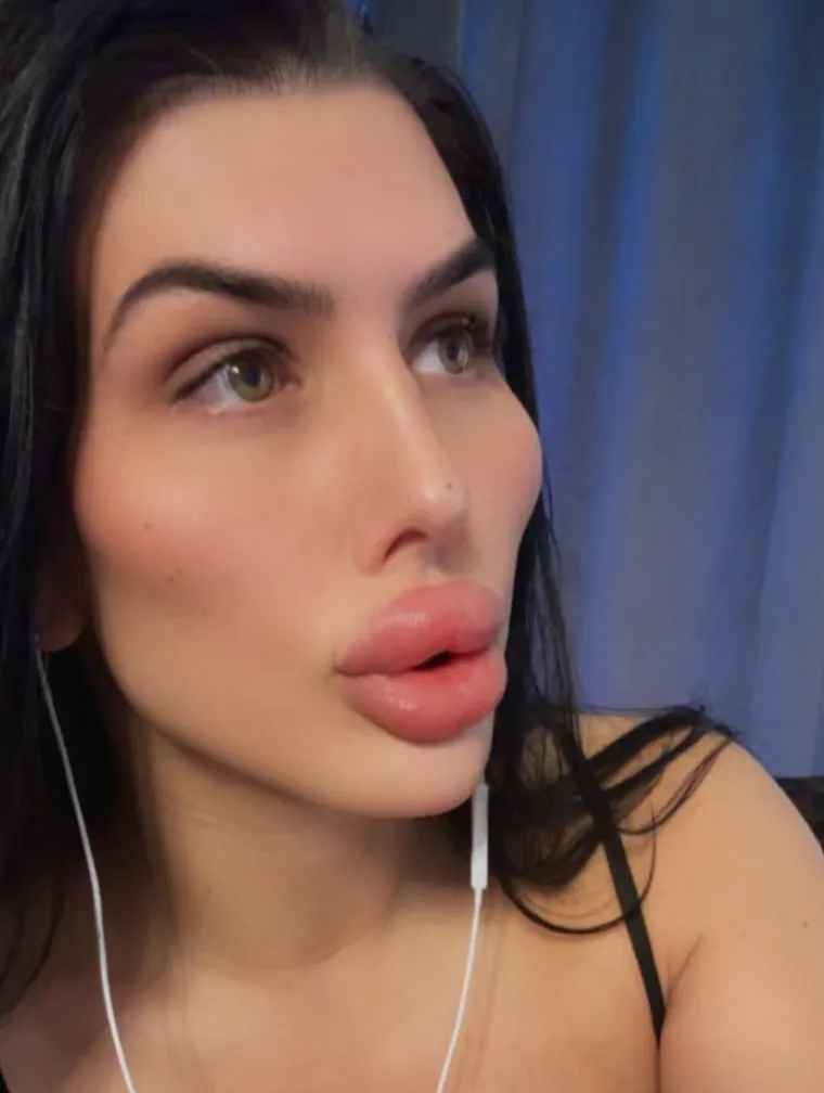 Godinama je punila obraze filerima, a sada je odlučila vratiti prirodno lice: Promjena je ogromna