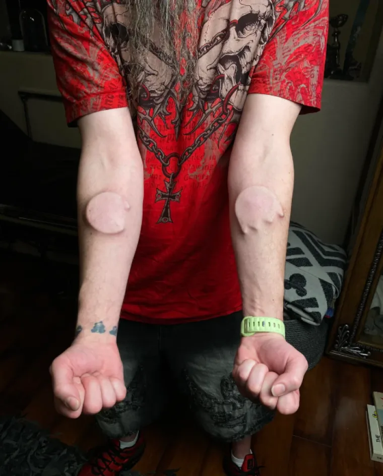 Ljudi su podijelili svoje najbizarnije modifikacije na tijelu: Neke su ba&scaron; zastra&scaron;ujuće