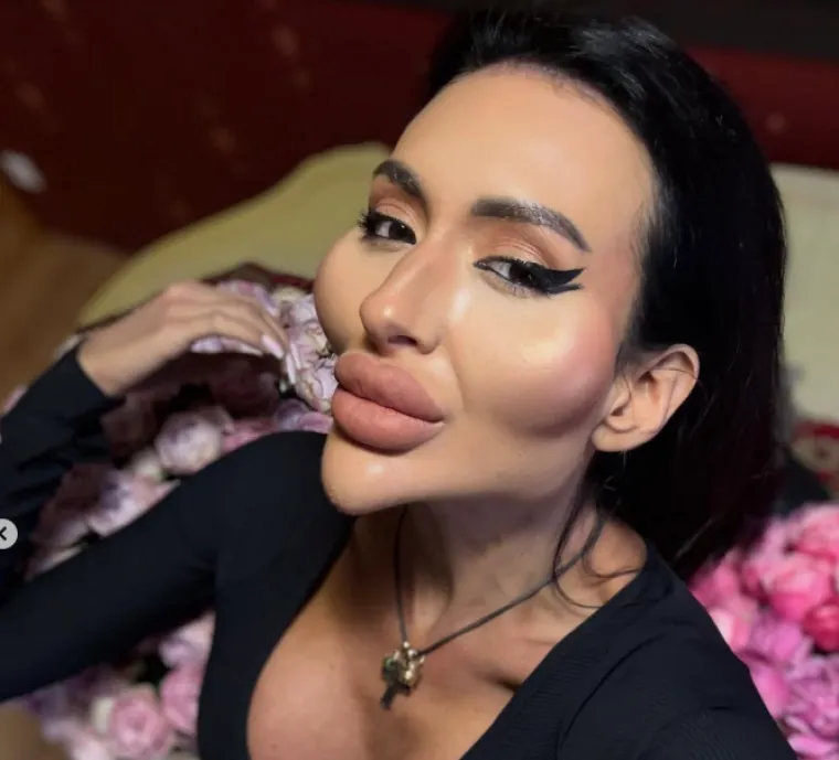 Ponosno nosi titulu žene s najvećim obrazima: Prije je bila prava ljepotica, evo kako je izgledala