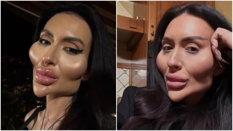 Ponosno nosi titulu žene s najvećim obrazima: Prije je bila prava ljepotica, evo kako je izgledala