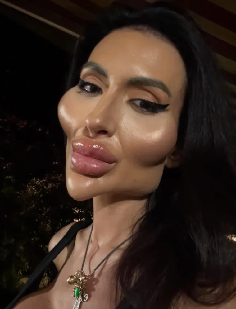 Ponosno nosi titulu žene s najvećim obrazima: Prije je bila prava ljepotica, evo kako je izgledala