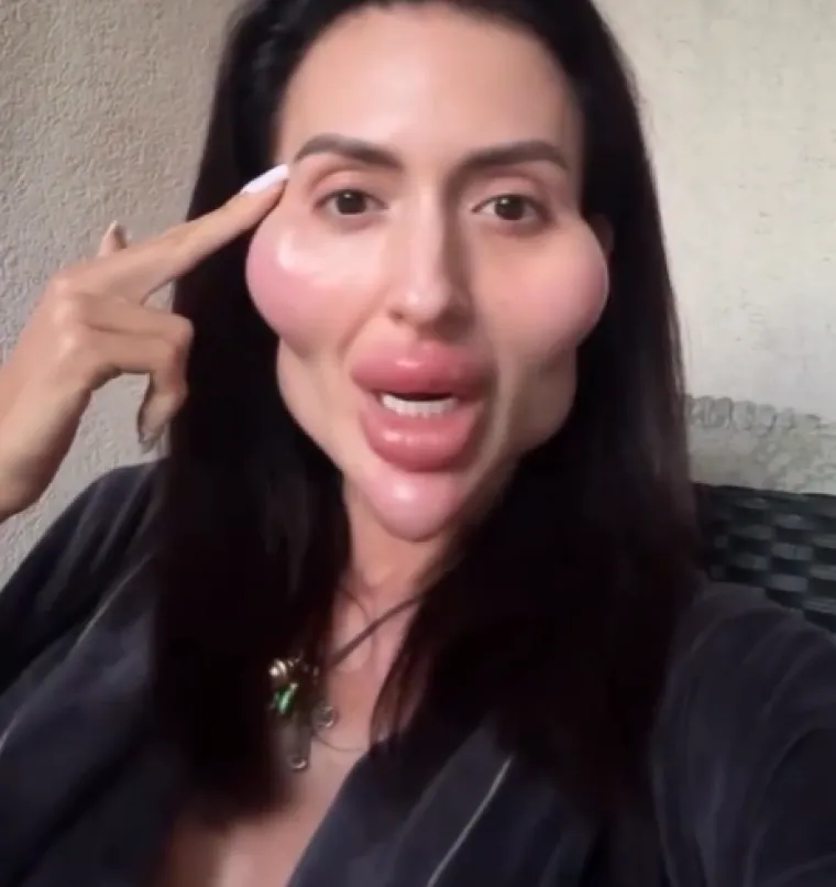 Ponosno nosi titulu žene s najvećim obrazima: Prije je bila prava ljepotica, evo kako je izgledala