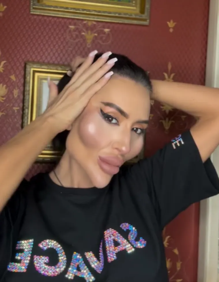 Ponosno nosi titulu žene s najvećim obrazima: Prije je bila prava ljepotica, evo kako je izgledala