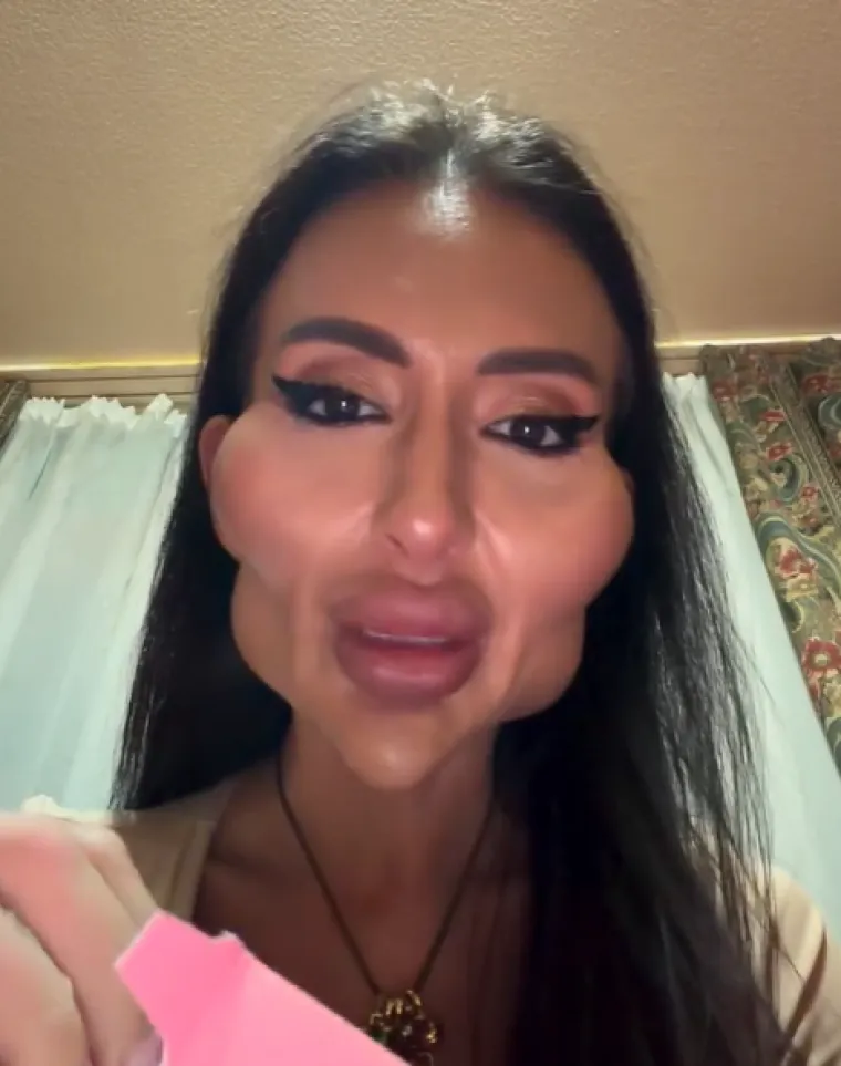 Ponosno nosi titulu žene s najvećim obrazima: Prije je bila prava ljepotica, evo kako je izgledala