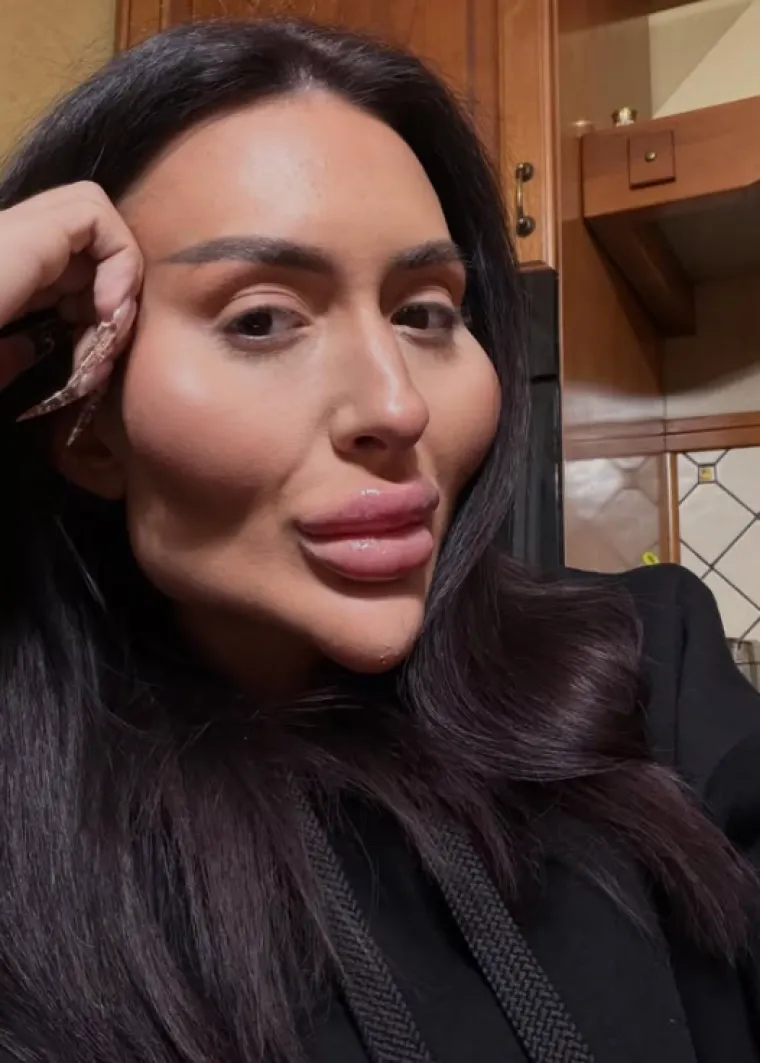 Ponosno nosi titulu žene s najvećim obrazima: Prije je bila prava ljepotica, evo kako je izgledala