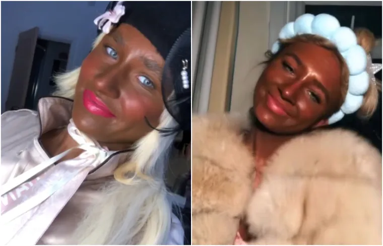 Ovisna je o solariju do te mjere da si je unakazila kožu, a ba&scaron; je bila slatka djevojka