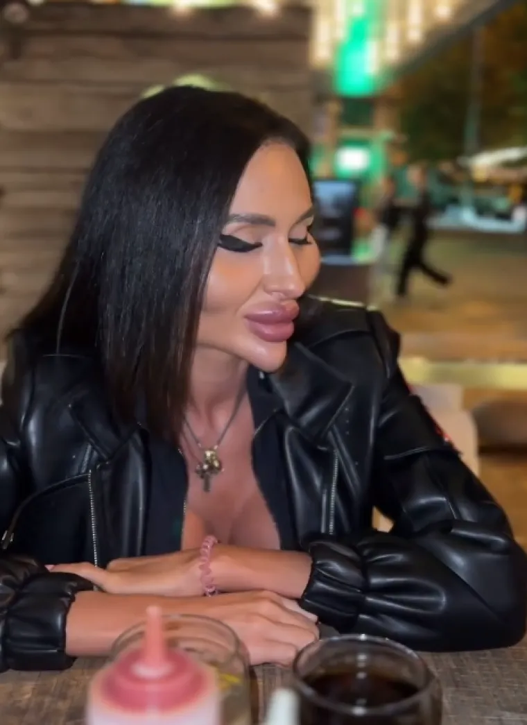 Žena s najvećim obrazima u dugotrajnom je procesu otapanja filera: Promjene su već vidljive