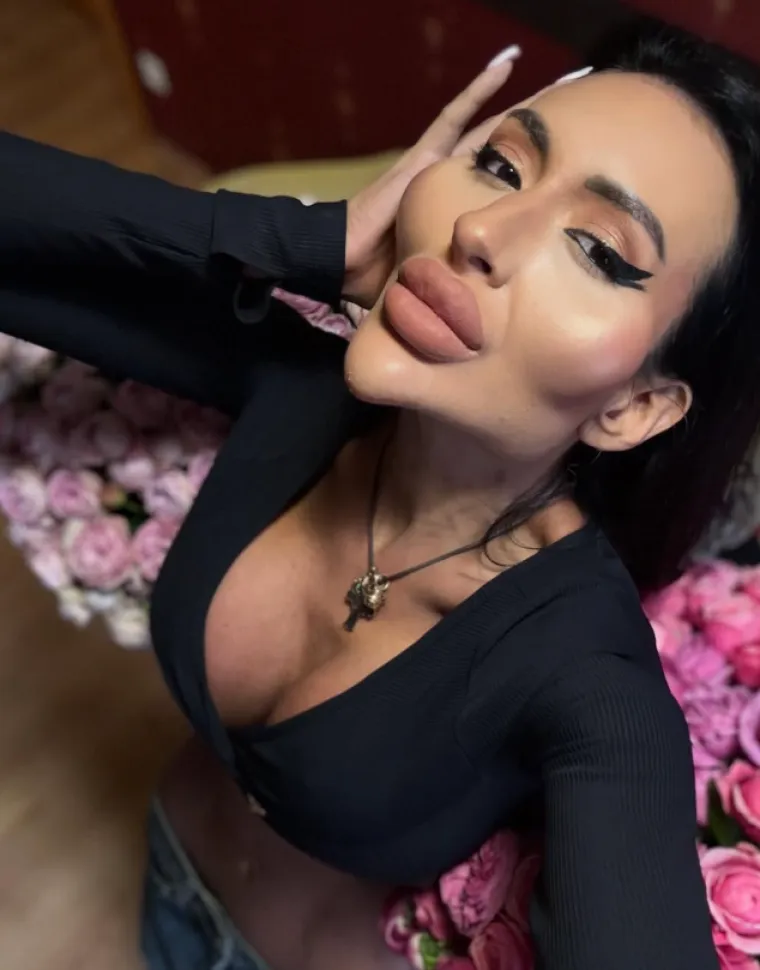 Žena s najvećim obrazima u dugotrajnom je procesu otapanja filera: Promjene su već vidljive