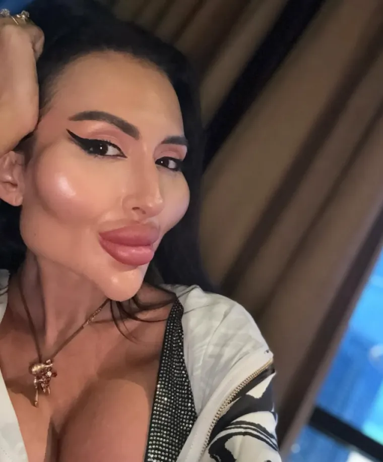 Žena s najvećim obrazima u dugotrajnom je procesu otapanja filera: Promjene su već vidljive