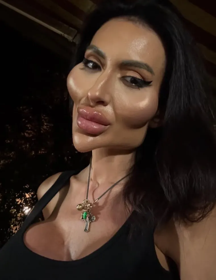 Žena s najvećim obrazima u dugotrajnom je procesu otapanja filera: Promjene su već vidljive
