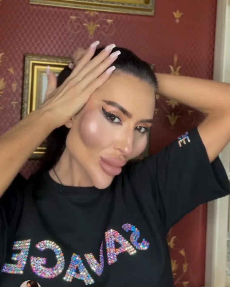 Žena s najvećim obrazima u dugotrajnom je procesu otapanja filera: Promjene su već vidljive