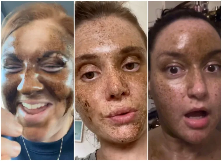Htjele su brončani ten, a dobile lice iz noćne more: Sprej za samotamnjenje ih je ba&scaron; unakazio