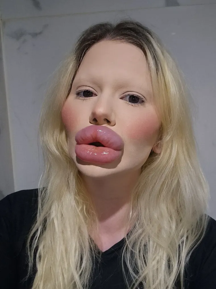 Žena s najvećim usnama na svijetu pokazala kako je izgledala prije: Bila je prava ljepotica