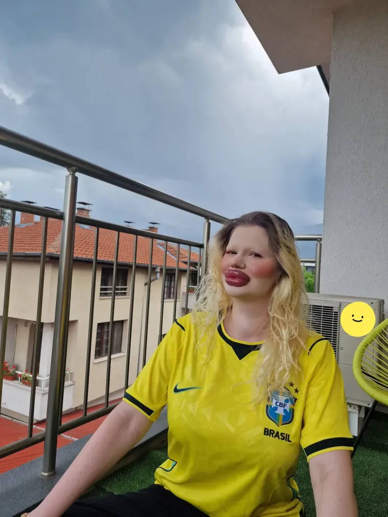 Žena s najvećim usnama na svijetu pokazala kako je izgledala prije: Bila je prava ljepotica