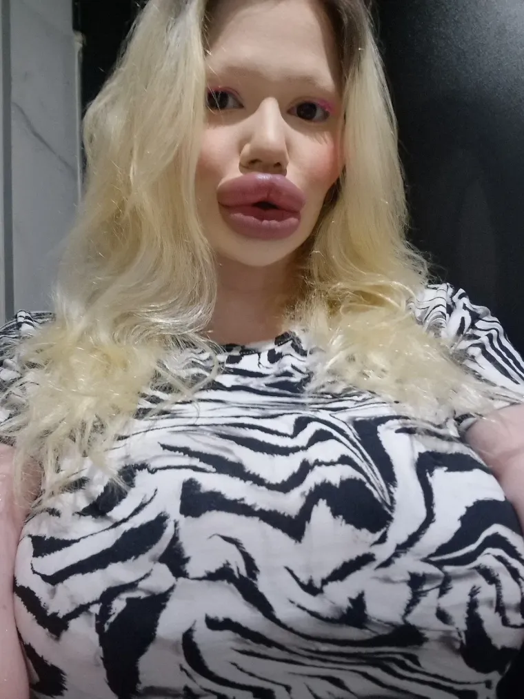 Žena s najvećim usnama na svijetu pokazala kako je izgledala prije: Bila je prava ljepotica