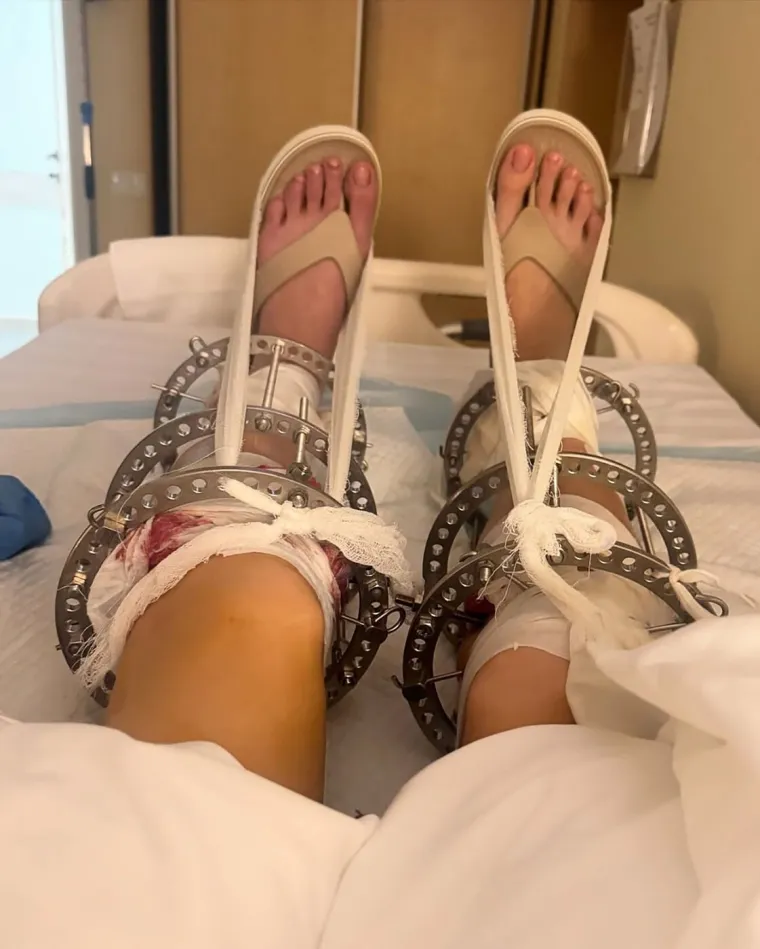 &Scaron;okantna odluka modela: Dobrovoljno dala slomiti noge zbog karijere
