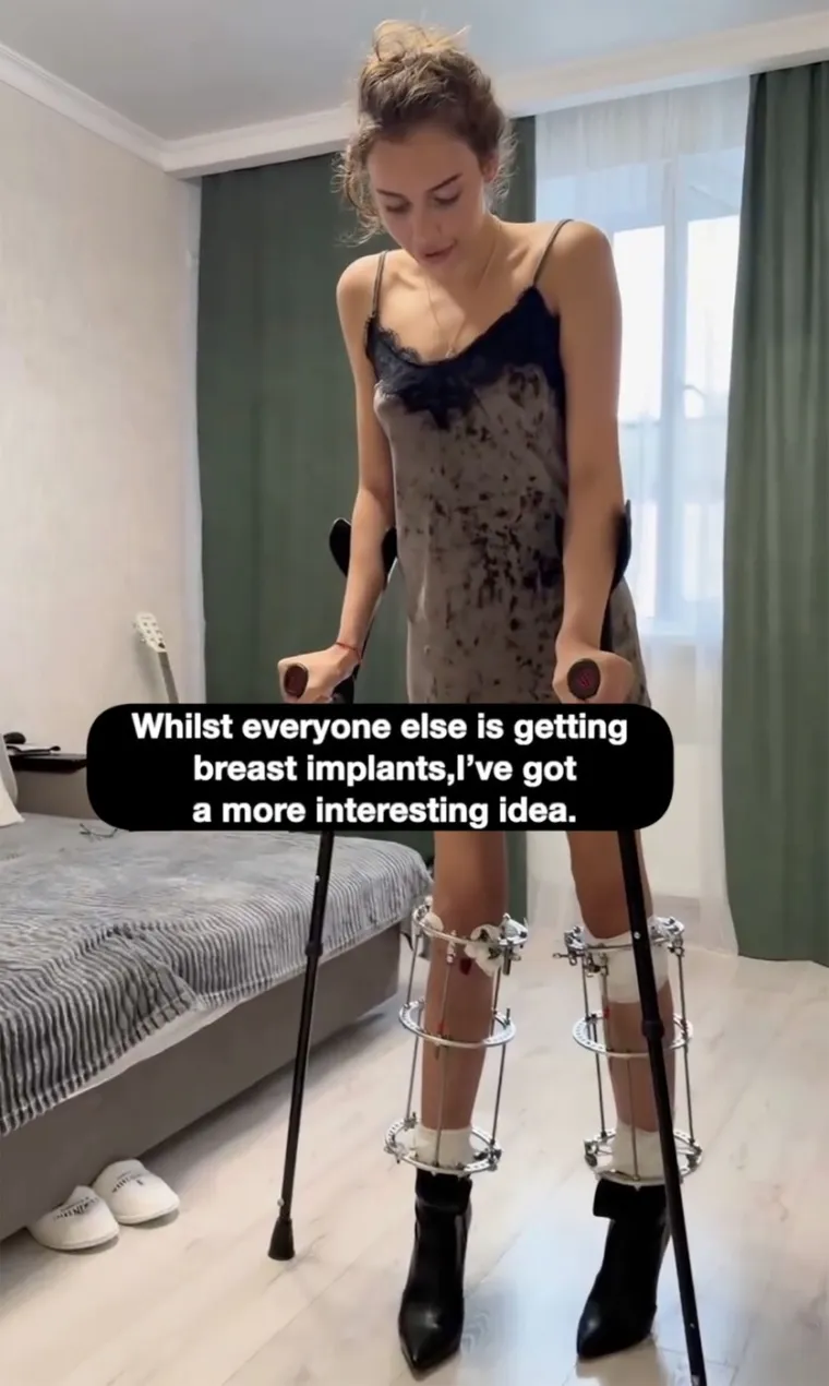 &Scaron;okantna odluka modela: Dobrovoljno dala slomiti noge zbog karijere