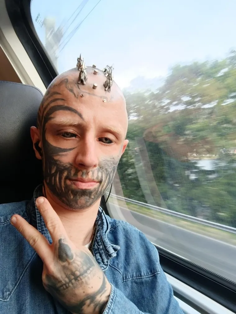 Slijepi mu&scaron;karac s metalom u glavi i crnim očima &scaron;okira pojavom: Evo kako je izgledao prije
