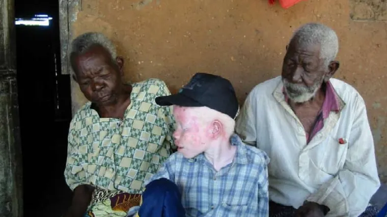 Obredna ubojstva albino ljudi