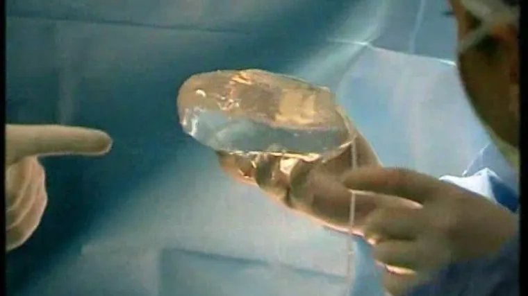 Na Rebru besplatno ugrađuju silikone