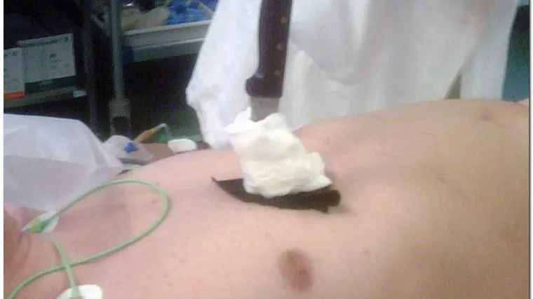 Na Rebru spasili pacijenta s nožem u srcu