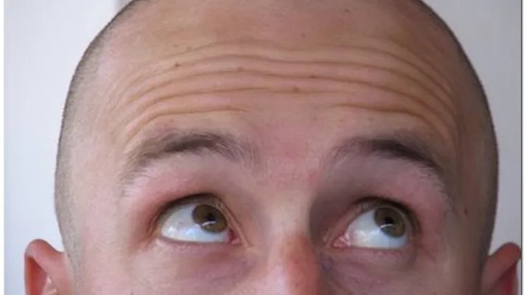 Gen odgovoran za ćelavost