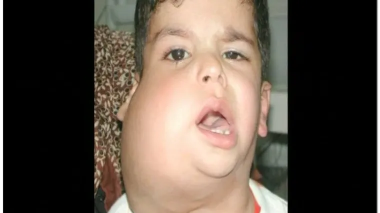 Dječaku uspje&scaron;no odstranjen ogroman tumor