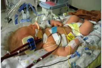 Prva beba u Hrvatskoj na umjetnom srcu i plućima