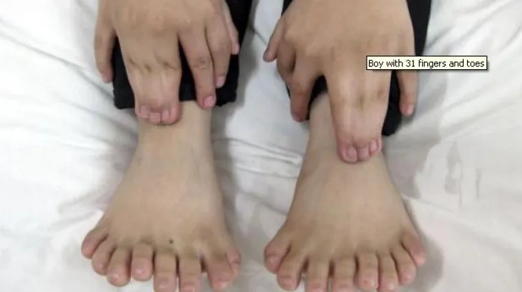 Kirurzi dječaku odstranili 11 prstiju