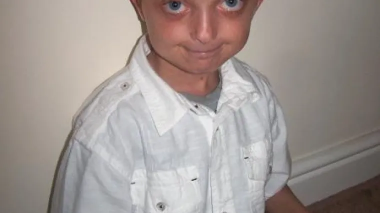 Dječak (11) s licem starca, stari najbrže na svijetu