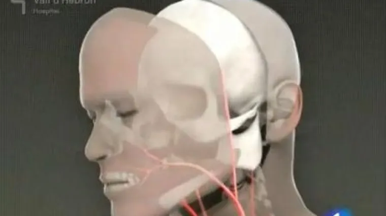 Prvo potpuno presađivanje lica