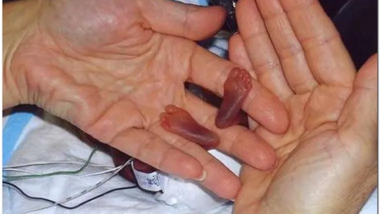 Dječak živio dva dana nakon pobačaja