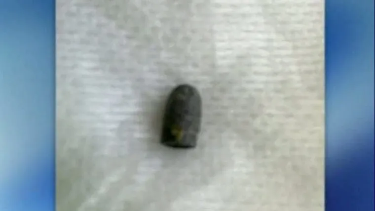 Živio s metkom u glavi a da o tome pojma nije imao