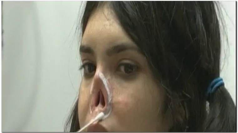 Mlada Afganistanka dobila zamjenski nos