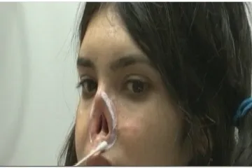 Žena mučena u Afganistanu dobila novi nos
