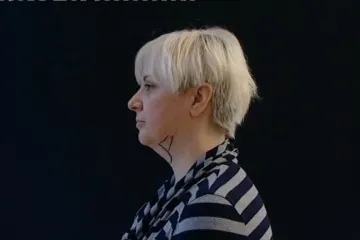 Danijela Dvornik na liposukciji podbratka