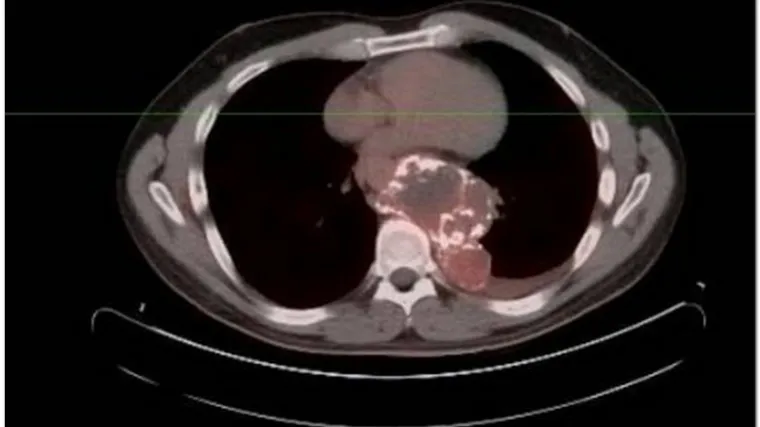 U Amerikancu rastao "tumor alien"