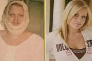 Na prvoj liposukciji sa 12 godina