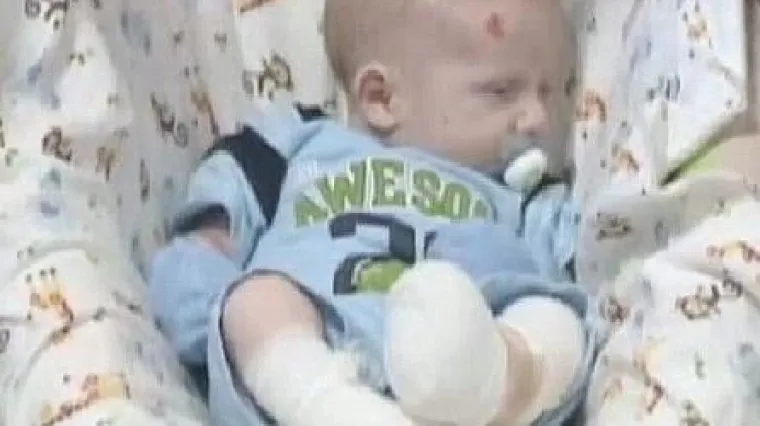 Beba rođena bez kože