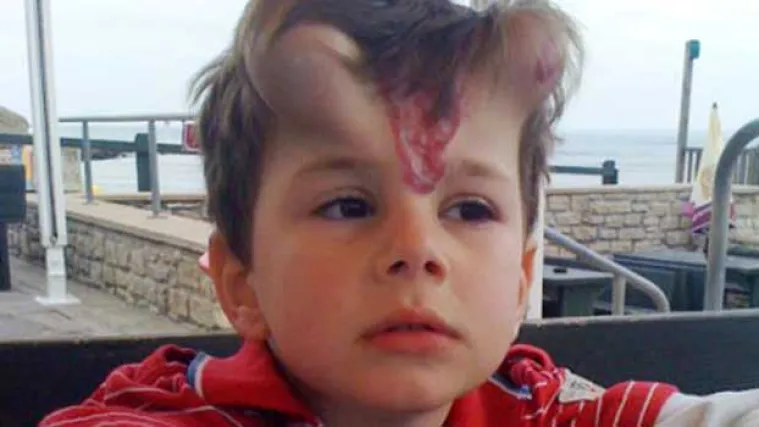 Dječaku ugradili rogove da mu uklone ožiljak