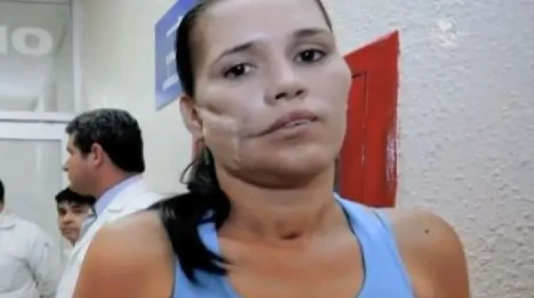 Granata joj probila obraz i ostala u njemu