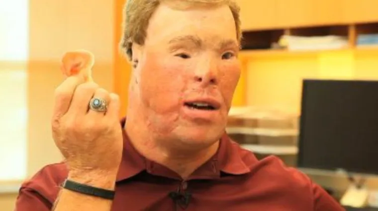 Nakon 43 operacije dobio 'novo' lice