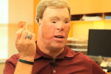 Nakon 43 operacije dobio 'novo' lice