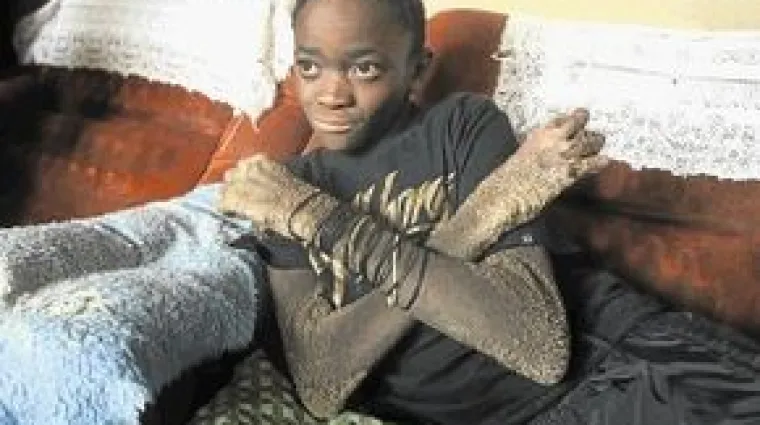 Dječak rođen s kožom koja se lju&scaron;ti poput zmijske