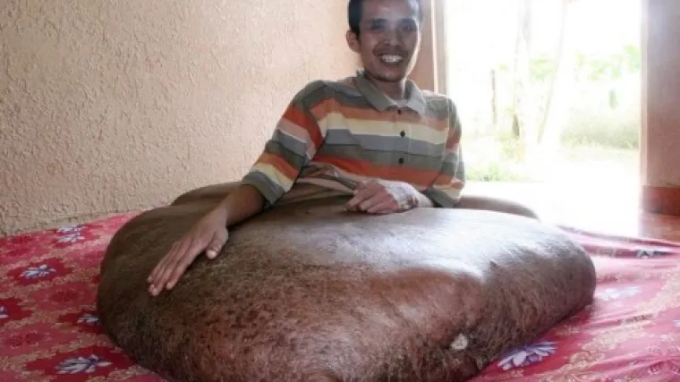 Odstranjen rekordni tumor od 90 kilograma!