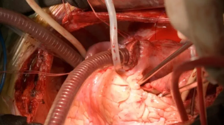 Čovjek s dva srca preživio dvostruki infarkt